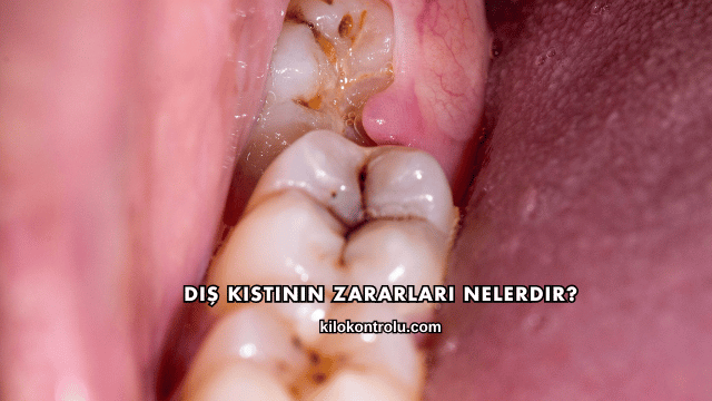 Diş Kistinin Zararları Nelerdir?