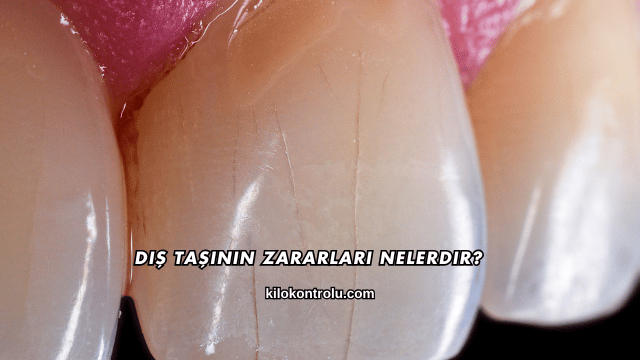 Diş Taşının Zararları Nelerdir?